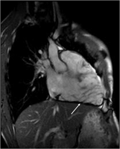 МРТ сердца при аритмогенной дисплазии правого желудочка (АДПЖ)
