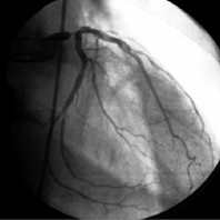 Коронарограмма левой коронарной артерии: критический стеноз ствола ЛКА с хорошим дистальным руслом