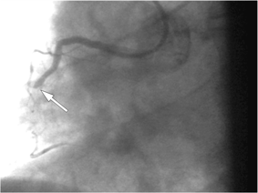 Коронарограмма правой коронарной артерии (ПКА): окклюзия (полное сужение) средней трети ПКА. Стрелкой указано место окклюзии.